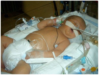 Baby Carter in the NICU