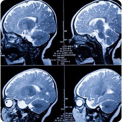 chiari malformation